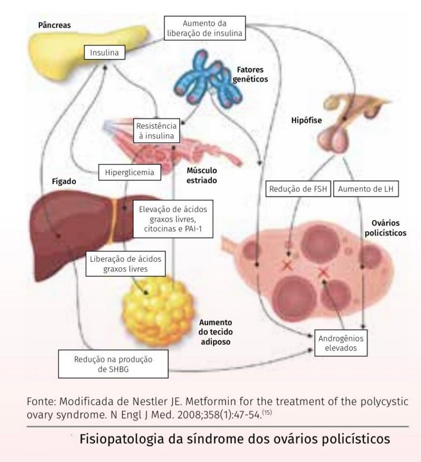 Fisiopatologia da Sindrome dos Ovarios Policisticos